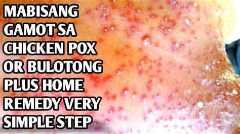 CHICKEN POX (BULUTONG): Tamang Gamutan .